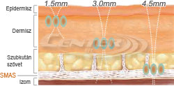 Microson Plus kezelés három mélységben (1,5 mm, 3,0 mm és 4,5 mm)